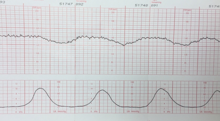 <p>Repetitive and periodic slowing of the FHR with onset mid to end of the contraction and the lowest point more than 20 seconds after the peak of the contraction, and ending after the contraction.</p>