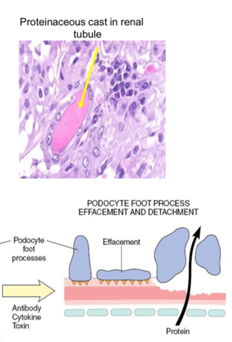 <p>Group of clinical signs and symptoms caused by excessive protein loss in urine</p><p>Low protein edema &amp; effusions into body cavities with hypercoagulability &amp; hypercholesterolemia</p>