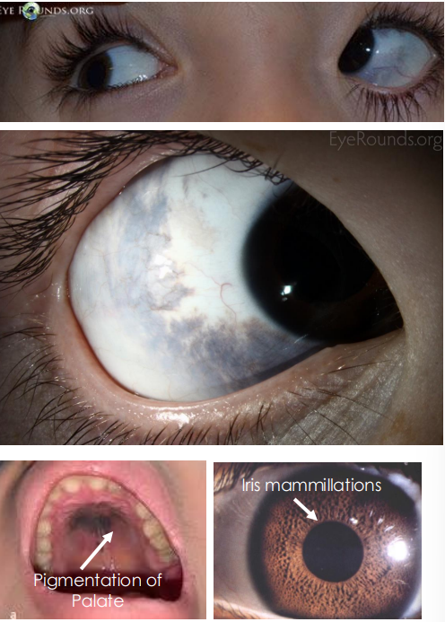 <p>• Flat,<strong><u> blue-grayish, patchy </u></strong>pigmentation of conjunctiva and sclera; Tends to follow <strong><u>CN 5 V1 &amp; V2 distribution </u></strong>• Can have i<strong><u>ris mammillations </u></strong>• Often <strong><u>Unilateral</u></strong>, bilateral in only10% cases • Risk of congenital glaucoma</p>