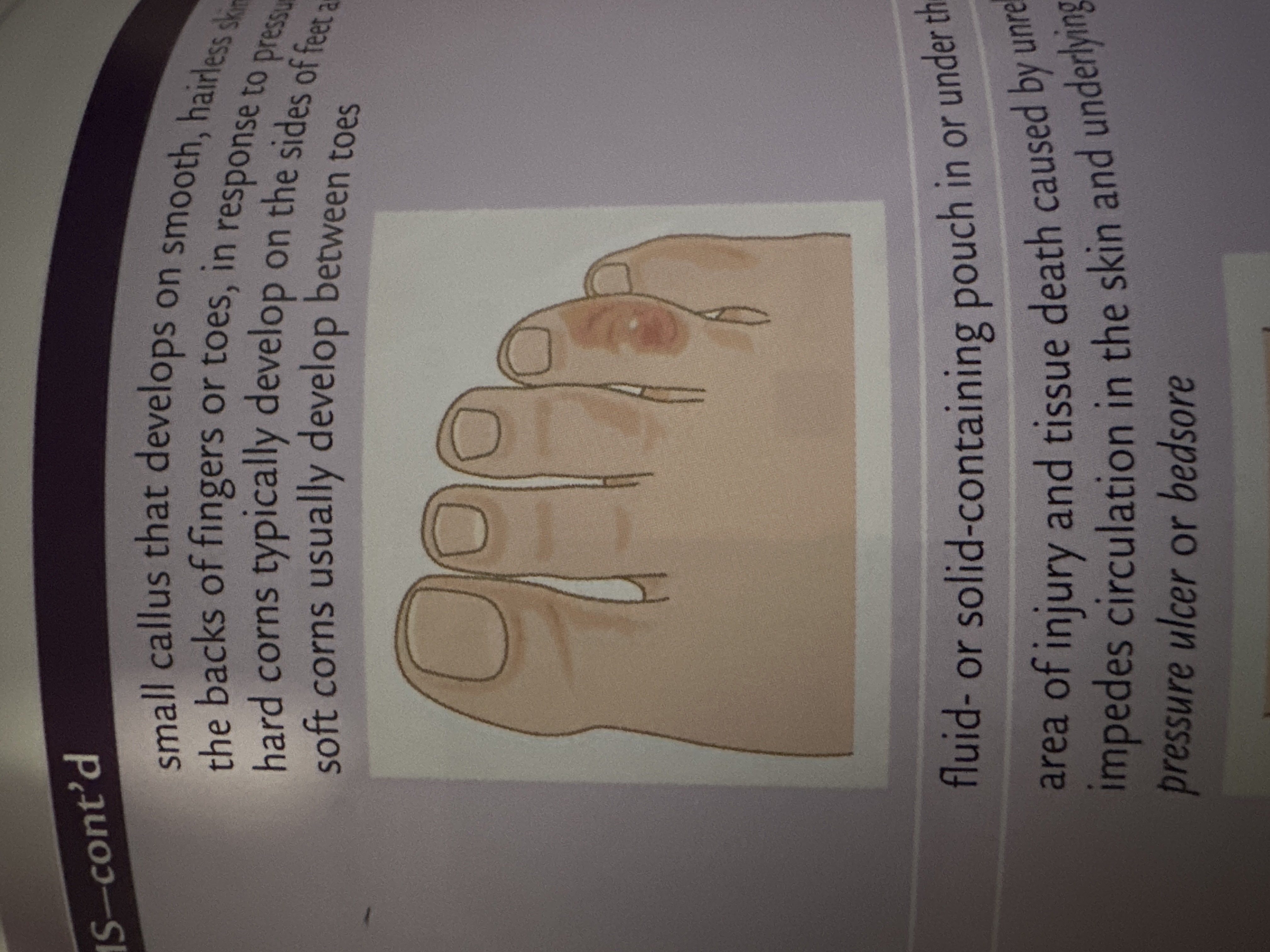 small callus that develops on smooth, hairless skin surfaces, such as the backs of fingers or toes, in response to pressure and friction; hard corns typically develop on the sides of feet and tops of toes; soft corns usually develop between toes
