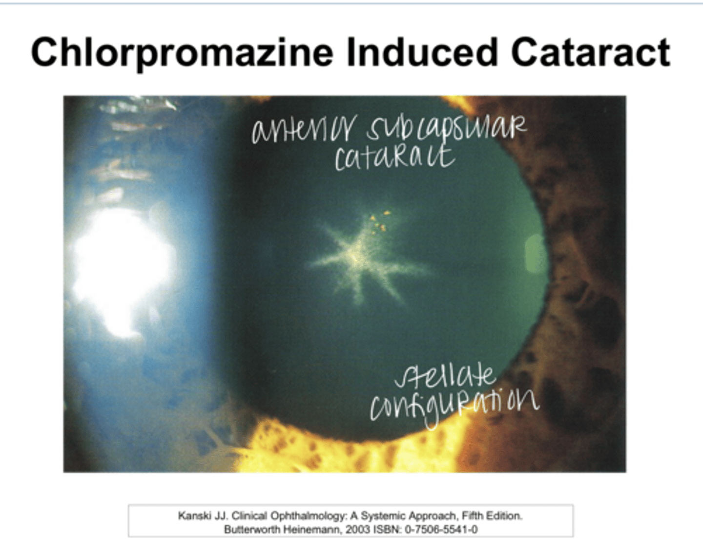 <p>Chlorpromazine Induced Cataract Pic</p>