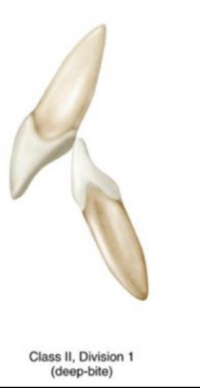 <p><strong>Malocclusion, deep bite</strong>, increased overjet </p>