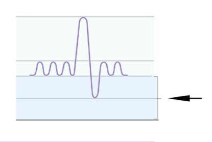 <p>The lung volume or capacity indicated by the arrow in the following figure is</p><p>A. Inspiratory reserve volume (IRV)</p><p>B. Expiratory reserve volume (ERV)</p><p>C. Residual volume (RV)</p><p>D. Vital capacity (VC)</p><p>E. Functional residual capacity (FRC)</p>