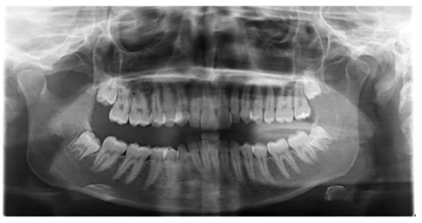 <p>Are there any supernumerary teeth?</p>