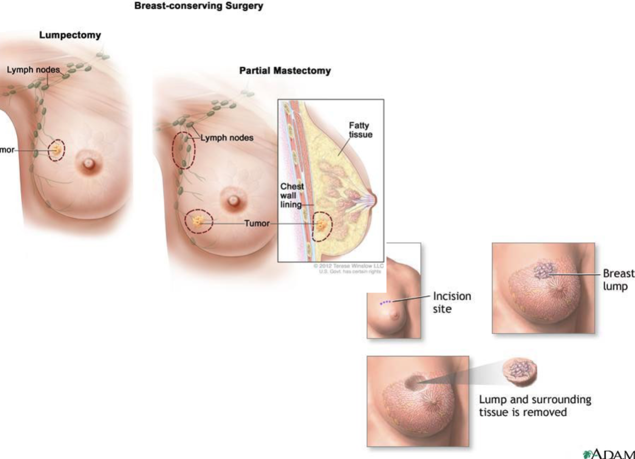 <p>removal of only the tumor + a small rim of tissue, keeping most of the breast.</p><p><br>May be done with or without:</p><ul><li><p>Axillary lymph node dissection (LND)</p></li><li><p>Sentinel lymph node biopsy (SLND)</p></li></ul><p></p>