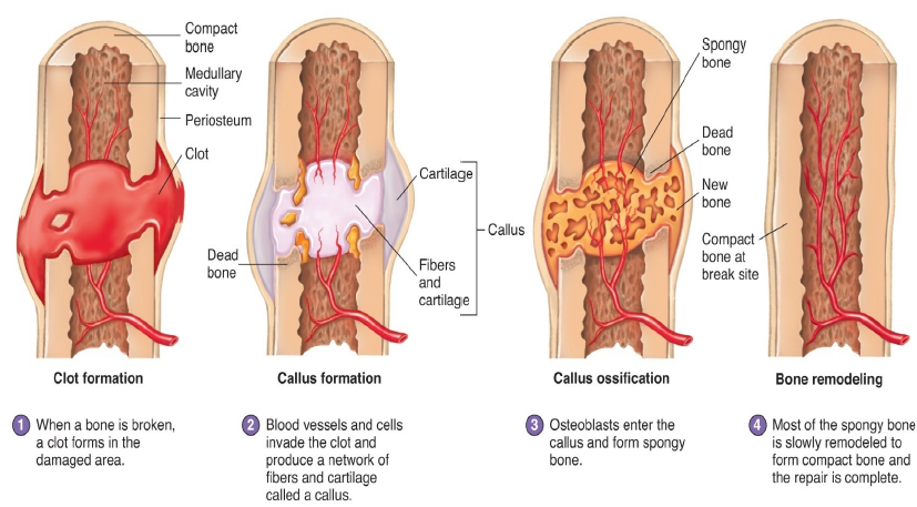 <ol><li><p>Broken bone causes bleeding and a blood clot forms.</p></li><li><p>Callus forms which is a fibrous network between 2 fragments.</p></li><li><p>Cartilage model forms first then, osteoblasts enter the callus and form cancellous bone this continues for 4-6 weeks after injury.</p></li><li><p>Cancellous bone is slowly remodeled to form compact and cancellous bone.</p></li></ol>