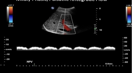 <p>which describes normal doppler waveform in the portal vein</p><p>.</p><p>a) mild pulsatility w/respiratory variation</p><p>b) blunted w/respiratory variation</p><p>c) prominent respiratory variation + mild pulsatility </p><p>d) moderately pulsatile flow due to vessel proximity to heart</p>
