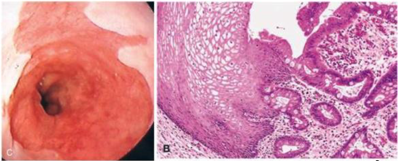 <p>52 yo female with GERD for past 10 years undergoes upper GI endoscopy to reveal an irregular gastroesophageal junction with salmon-pink colored mucosa. What kind of cells are present in the salmon-pink region?</p>