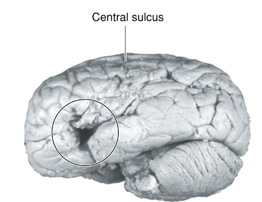 <p>did a lot of work with discovering the localization of function in the brain (research in acquired damage to the from regions of the brain, such as Broca’s area/frontal lobe of the dominant hemisphere)</p><p>specifically found the brain region necessary for speech</p>