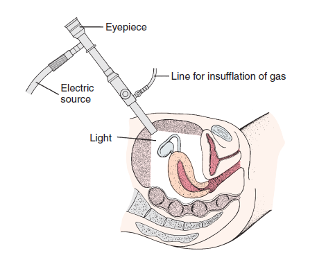 <p>Delicate adhesions may be divided and removed, and endometrial implants may be destroyed by electrocoagulation or laser </p>