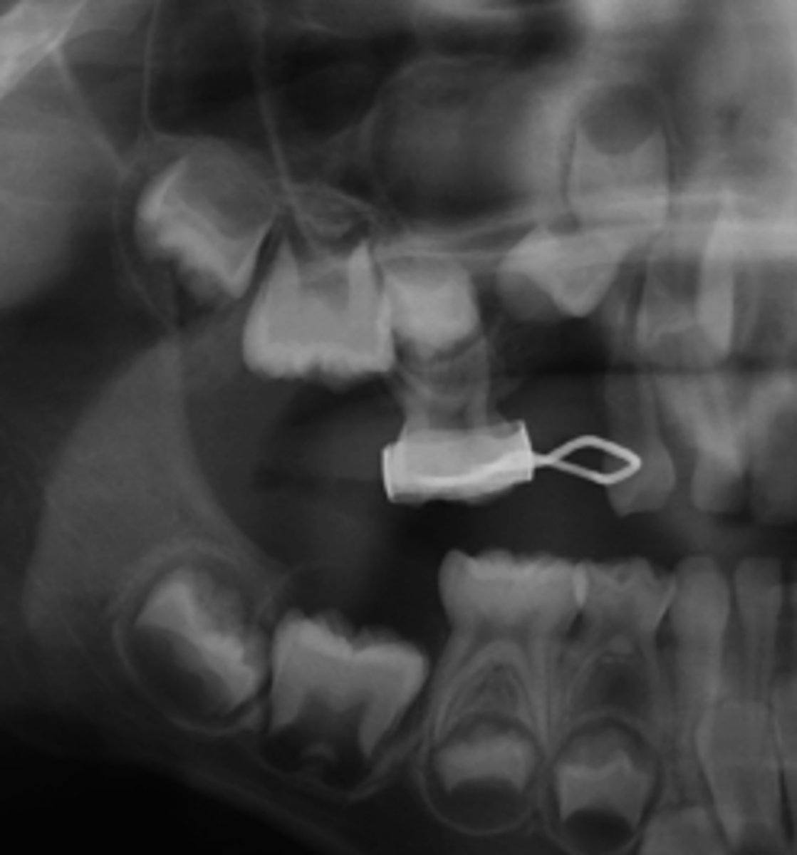<p>How do you know that this is NOT a Mucus Retention Pseudocyst?</p>