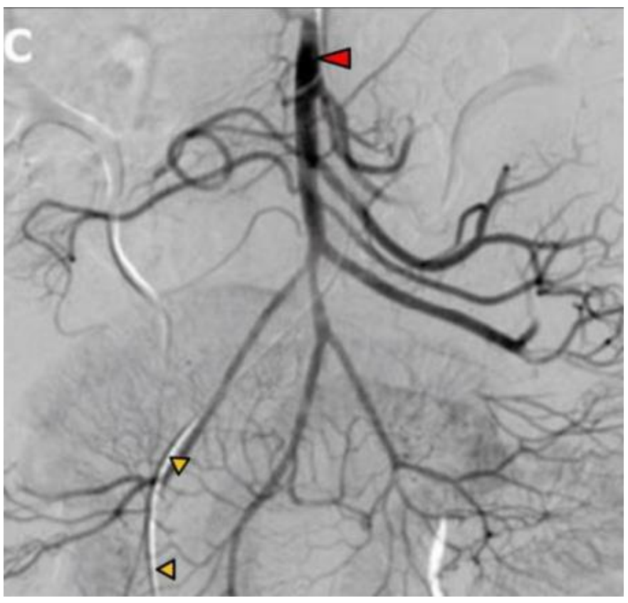 <p>An arteriogram from a 33-year-old female with abdominal pain reveals the image shown in the accompanying image. What artery is indicated by the red arrowhead?</p><p>A. Aorta</p><p>B. Celiac trunk</p><p>C. Inferior mesenteric artery</p><p>D. Internal iliac</p><p>E. Superior mesenteric artery</p>
