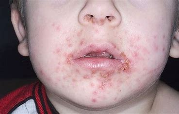 <p>= highly contagious bacterial infection of skin, most common in infants and children</p>