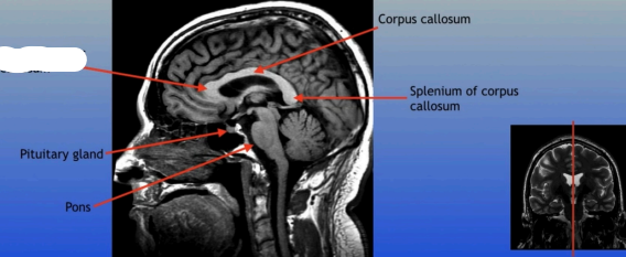 <p>The anterior part of the corpus callosum that connects the frontal lobes of the left and right hemispheres, playing a role in interhemispheric communication. </p>