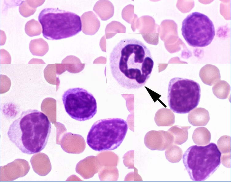 * Small cells w smooth, dense nuclear chromatin and a small rim of pale blue cytoplasm
* Larger forms can be seen in smaller #s normally
  * More abundant, pale cytoplasm
  * Can have scant, fine cytoplasmic granules
* RUMs tend to be larger w more abundant cytoplasm

Lymphs w azurophilic granules

* Can be seen normally
* Marked increase or majority of lymphs
  * Ehrlichia
  * Canine CLL (CD8 T cell)
  * Vax