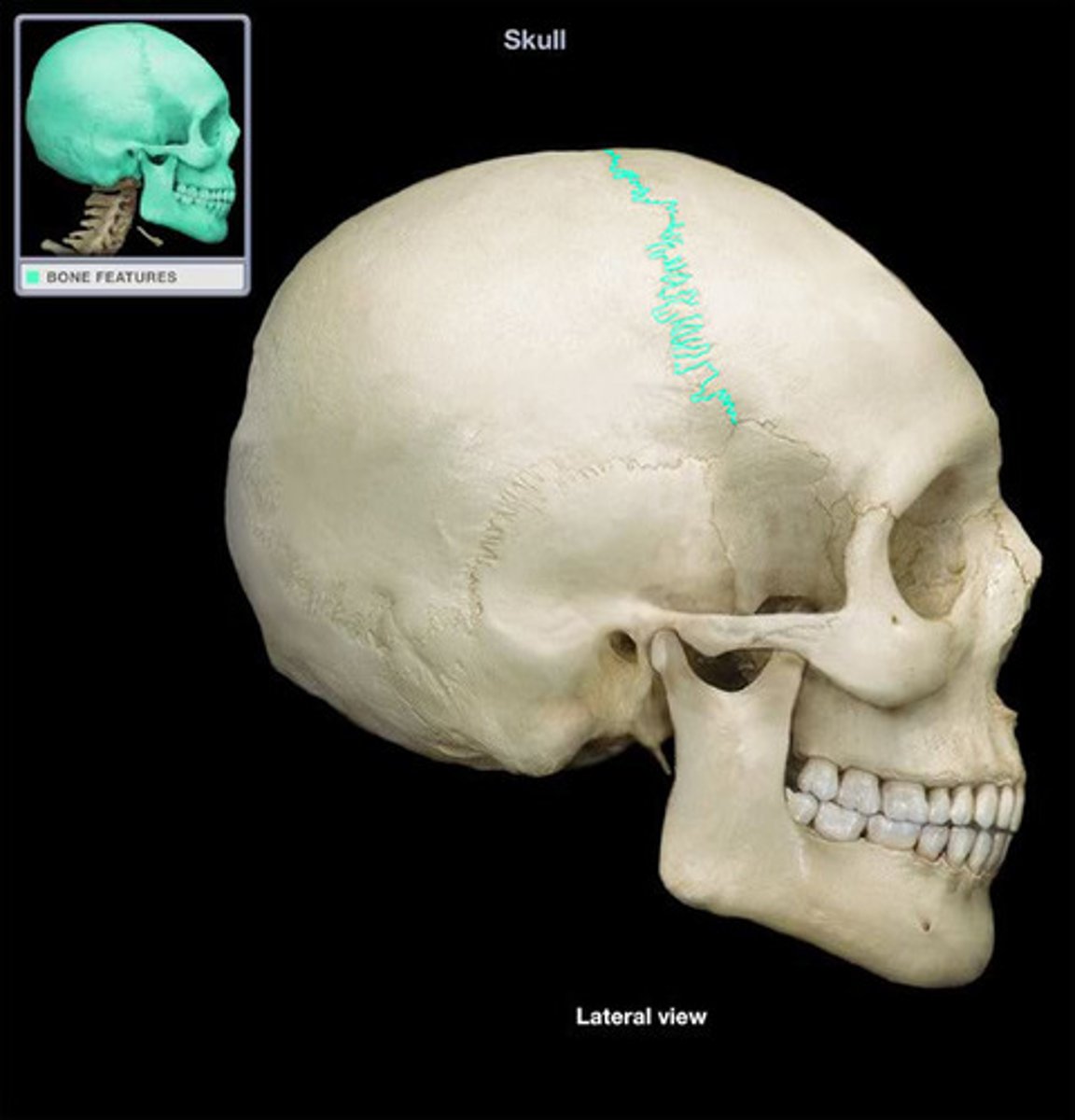 <p>between frontal and parietal bones</p>