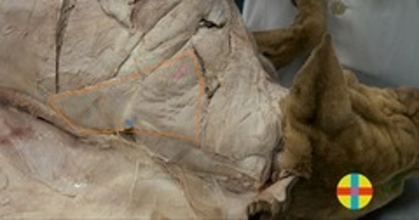 <p>porción cervical (se origina línea media dorsal de la zona cervical y se inserta en la espina de la escápula) y porción torácica (línea media dorsal de la zona torácica y se inserta en la espina de la escápula). </p><p>Origen: Lig. de la nuca y lig. supraespinoso</p><p>Inserción: Espina escápula</p><p>Función: fijador de la escápula.</p><p>Inervación: N. accesorio.</p>