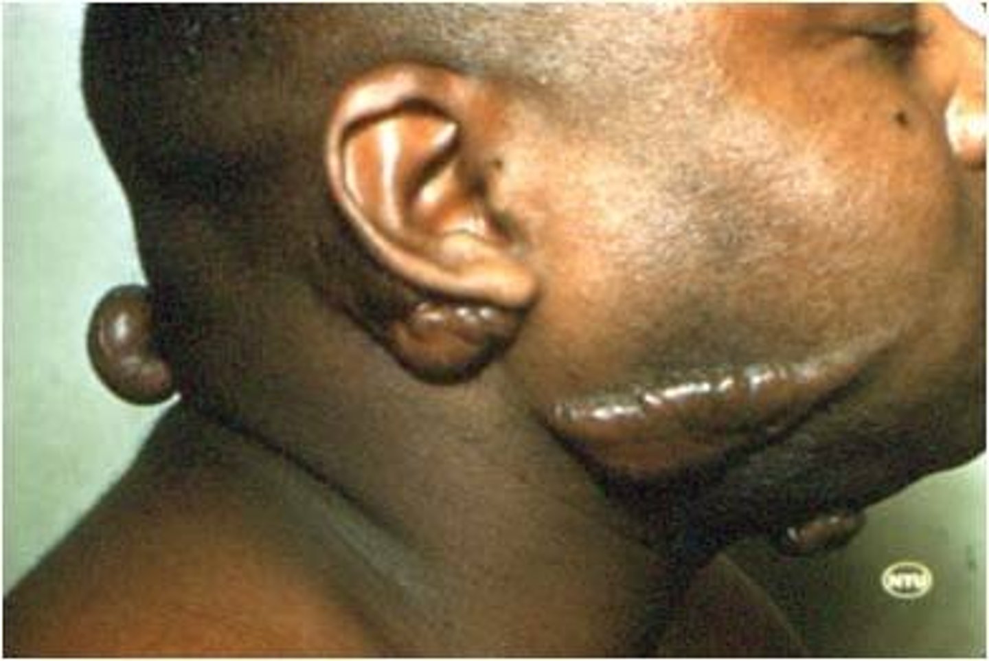 <p>secondary lesion; thick scar resulting from excessive growth of fibrous tissue</p>
