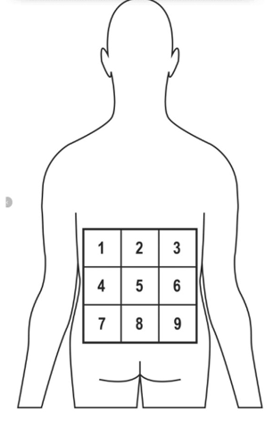 <p><span>Purpose:</span><br><span>To evaluate tactile localization accuracy and cortical sensory mapping in patients with low back pain.</span><br></p><p><span>Procedure:</span><br><span>1.Prepare the Grid:</span><br><span>Draw or place a 3x3 grid (9 blocks) over the lumbar region of the patient's back.</span><br><span>Ensure the grid is evenly spaced and covers the area of reported symptoms.</span><br><span>2.Instructions to Patient:</span><br><span>Inform the patient that you will lightly touch different areas within the grid and</span><br><span>they should identify the location of each stimulus.</span><br><span>3.Stimulus Application:</span><br><span>Use a pencil eraser or similar blunt object to gently touch one block at a time.</span><br><span>Randomize the order of stimulation to avoid pattern recognition.</span><br><span>4.Patient Response:</span><br><span>After each touch, ask the patient to point to or verbally identify the location</span><br><span>they felt the stimulus.</span><br><span>5.Scoring:</span><br><span>Record the number of correct responses out of 20. A score of ≥80% accuracy is</span><br><span>considered normal. Lower scores may indicate altered sensory processing or</span><br><span>central sensitization</span></p>