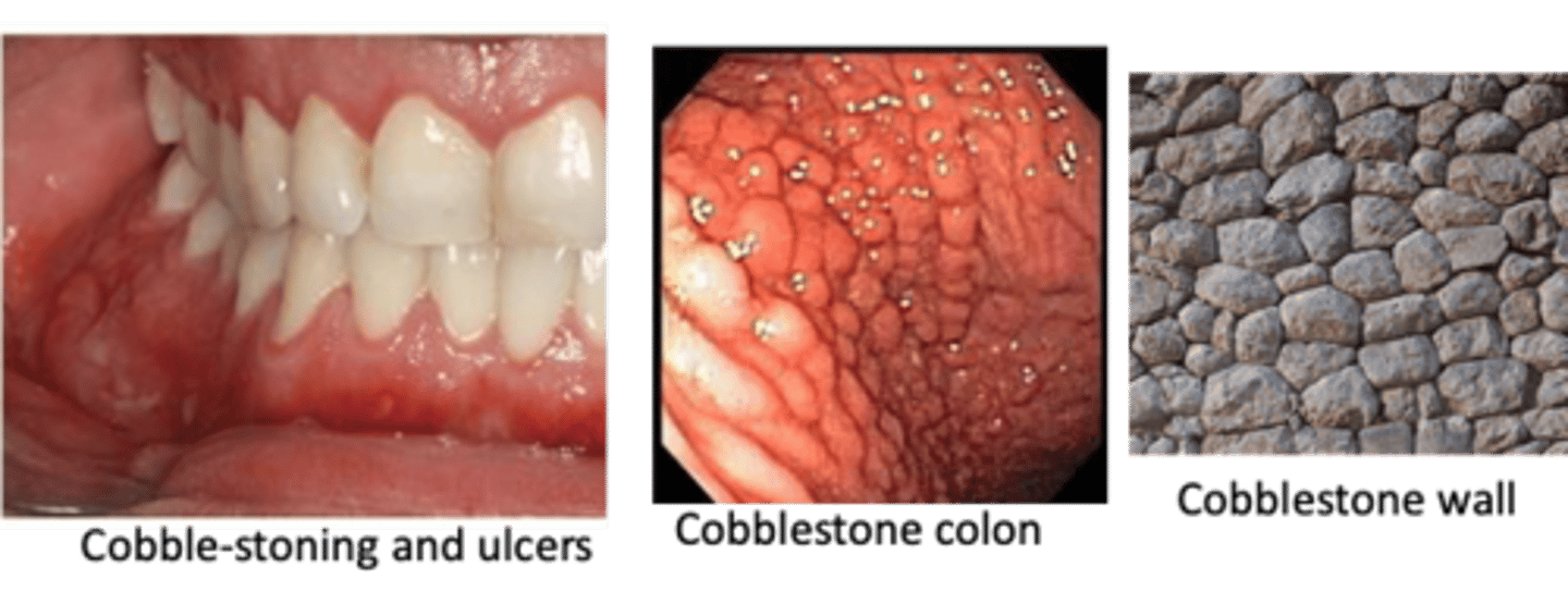 <p>____________ is an inflammatory bowel disease (IBD) characterized by bouts of abdominal pain, diarrhea, weight loss, nutritional deficiencies due to lesions involving anywhere in the GI tract, including oral cavity</p>