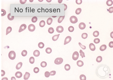 <p>what disease/condition is associated with dacrocytes?</p>