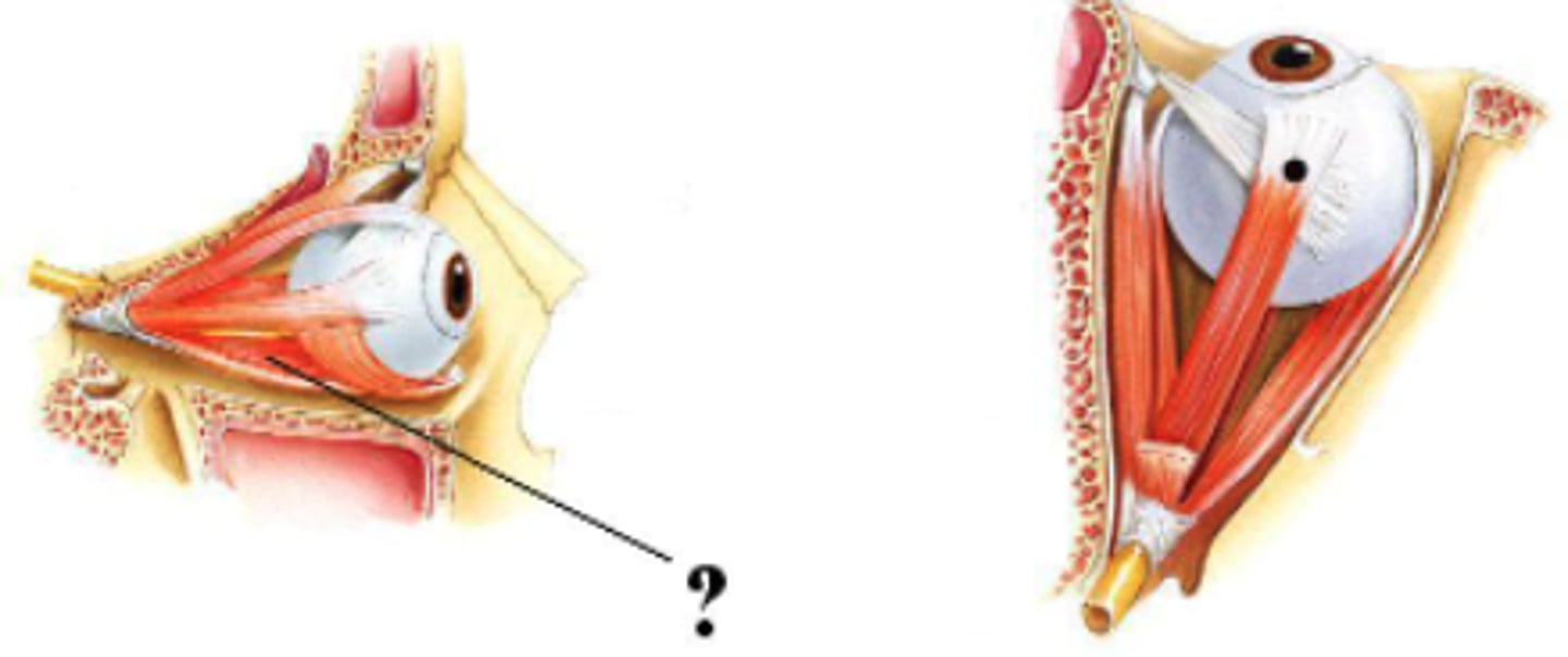 <p>inferior rectus muscle</p>