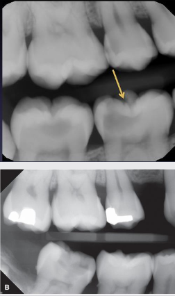 <ul><li><p><span style="color: #000000">Large lesions easily observed clinically and radiographically</span></p><ul><li><p><span style="color: #000000">Large, dark circles in crowns</span></p></li><li><p><span style="color: #000000">Pulp exposure can not always be determined</span></p></li></ul></li><li><p><span style="color: #000000">Not very effective at detecting small lesions</span></p><ul><li><p><span style="color: #000000">Minimum or no changes in enamel</span></p></li><li><p><span style="color: #000000">Near impossible to identify enamel-only lesions (enamel too thick)</span></p></li><li><p><span style="color: #000000">Thin line, triangle or cup shaped zone under enamel with base at DEJ</span></p></li></ul></li><li><p><span style="color: #000000">Easier to identify in panoramic radiographs</span></p></li><li><p><span style="color: #000000">Clinical exam important</span></p><ul><li><p><span style="color: #000000">High false negative rate in 2D radiographs</span></p></li></ul></li></ul><p></p>