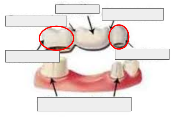 <p>The part of the bridge that fits over an abutment tooth and holds the bridge in place.</p>