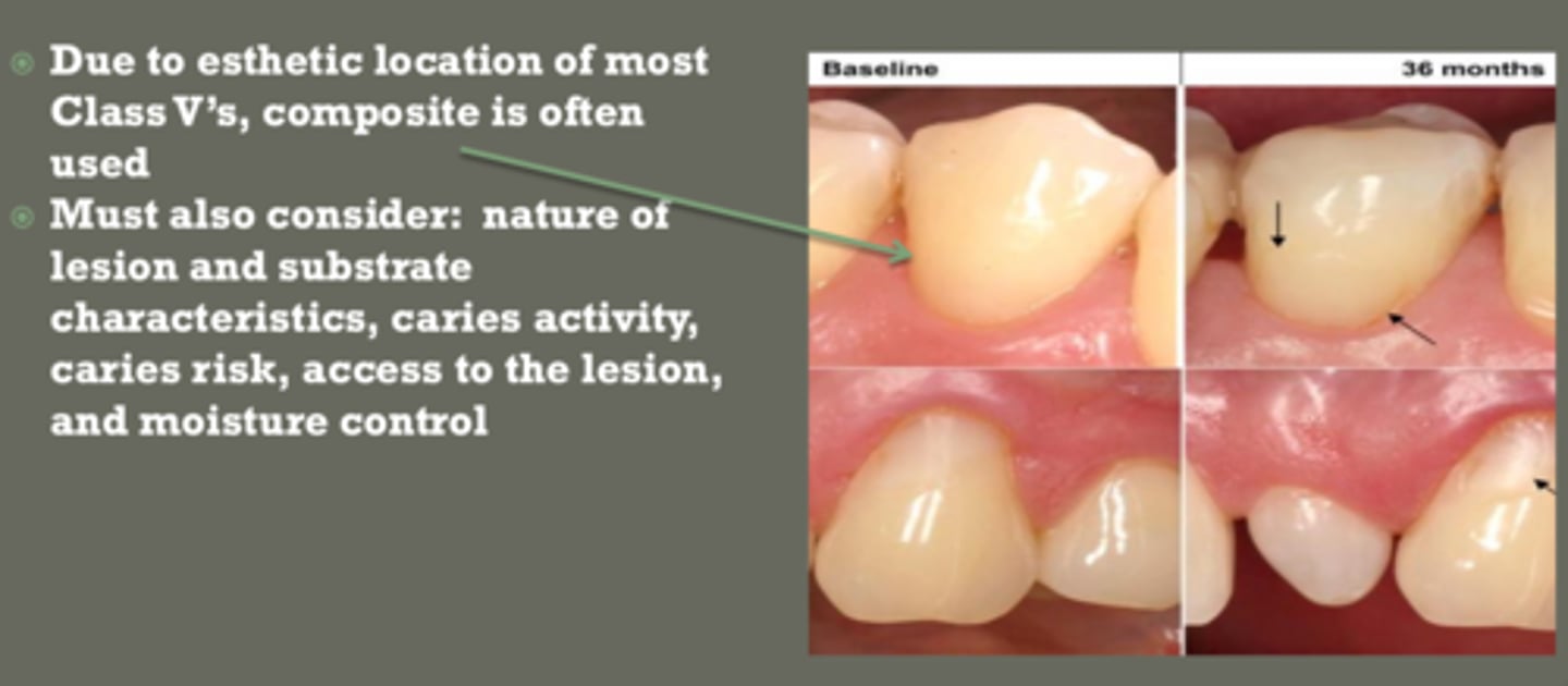 <p>use composite in esthetic zones</p><p>use GI:</p><p>- poor isolation</p><p>- high caries risk</p><p>- NCCLs</p>