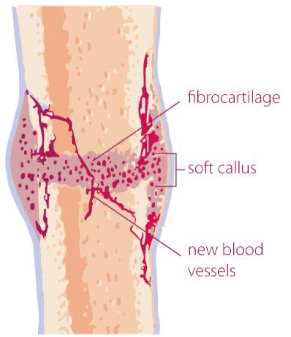 <p>within days of the fracture, capillaries grow into the hematoma, while phagocytic cells begin to clear away the dead cells</p><p>fibroblasts and osteoblasts enter the area and begin to reform bone</p><p>the repair tissue between the broken bone ends, the fibrocartilaginous callus, is composed of both hyaline and fibrocartilage</p><p>some bone spicules may also appear at this point</p><p>2-3 weeks</p>