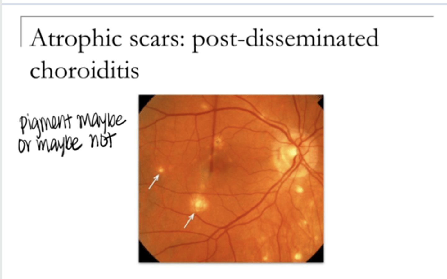<p>Atrophic Scars -- Post-Disseminated Choroiditis (Pic)</p>