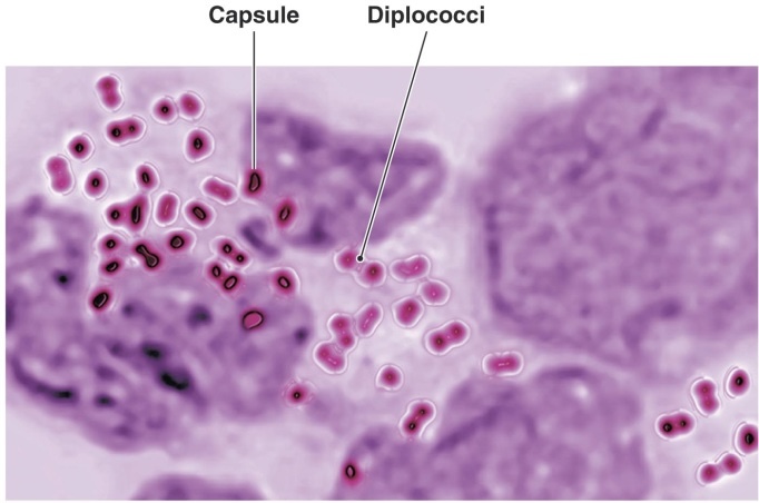<p><span>Agent: </span><em><span>Neisseria gonorrhoeae</span></em></p><p><span>Transmitted through: </span><span style="background-color: transparent;"><span>Sexual contact or via birth canal to newborns ( through newborns eyes) </span></span></p><p><span style="background-color: transparent;"><span>Identify parts of bacteria: capsule and diplococci </span></span></p><p><span style="background-color: transparent;"><span>Consequence of PID: damage to uterine tubes cause infertility </span></span></p>