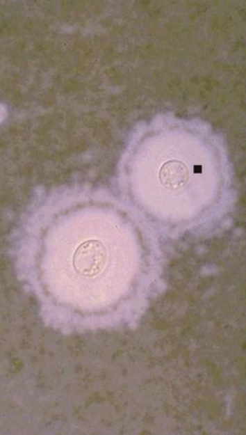 <p>8.10 Side B (PBD9: 387; BP9: 829)<br></p>
<p><br></p>
<p>Questions<br></p>
<p>A 37-year-old HIV-positive woman develops meningitis; India ink shows encapsulated yeast.<br></p>
<p><br></p>
<p>1. What opportunistic infection is this?<br></p>
<p>2. What is her CD4+ count likely to be?<br></p>
<p>3. What virulence factor prevents phagocytosis?<br></p>