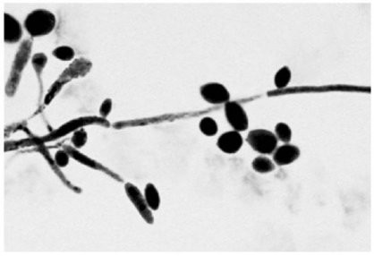 <p>The presence of the specimen shown in the figure in a vaginal discharge is evidence of infection with</p><table><tbody><tr><td colspan="1" rowspan="1"><p><em>Chlamydia trachomatis</em>.</p></td></tr><tr><td colspan="1" rowspan="1"><p><em>Candida albicans</em>.</p></td></tr><tr><td colspan="1" rowspan="1"><p><em>Treponema palladium</em>.</p></td></tr><tr><td colspan="1" rowspan="1"><p><em>Trichomonas vaginalis</em>.</p></td></tr><tr><td colspan="1" rowspan="1"><p><em>Neisseria gonorrhoeae</em>.</p></td></tr></tbody></table>
