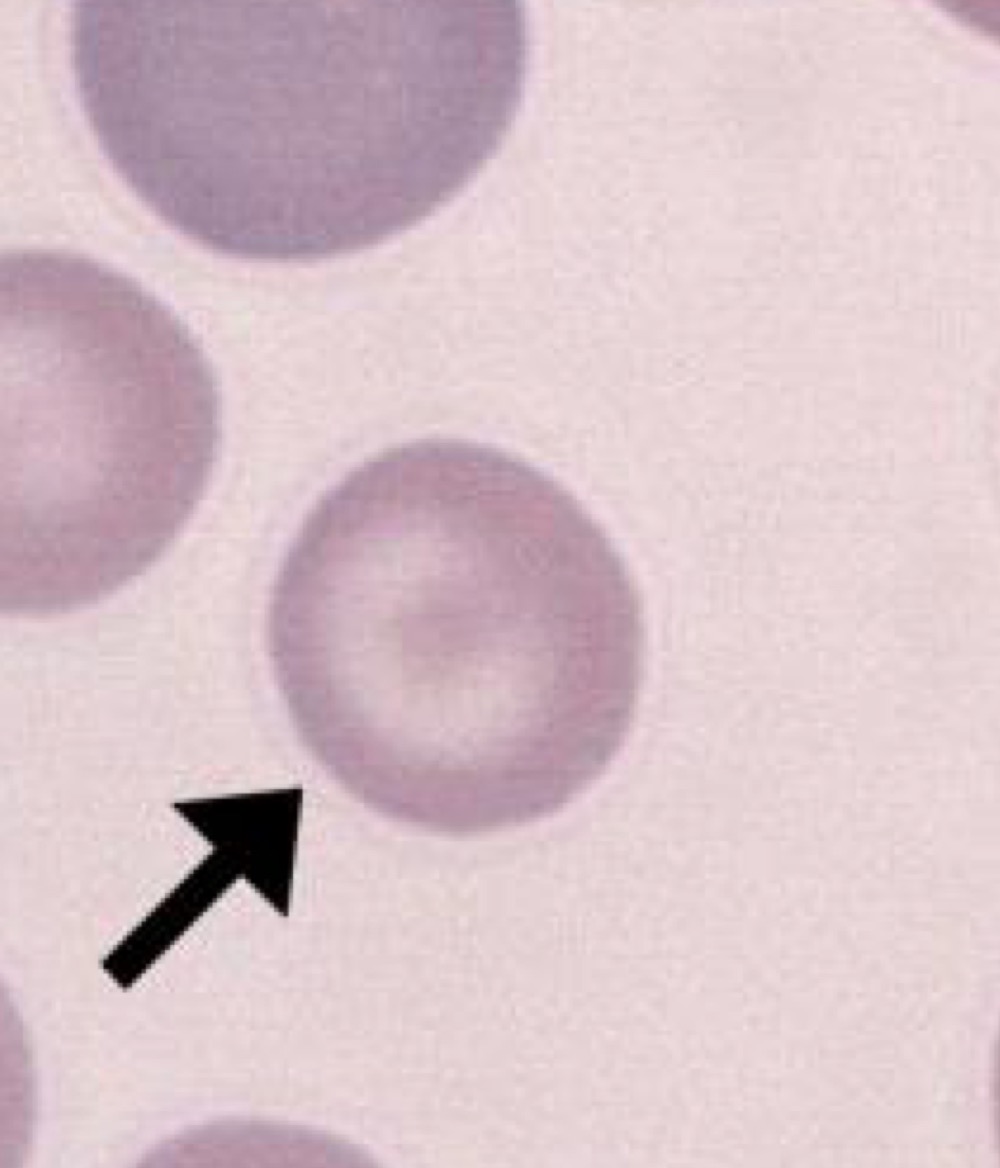 Name this RBC Abnormality.