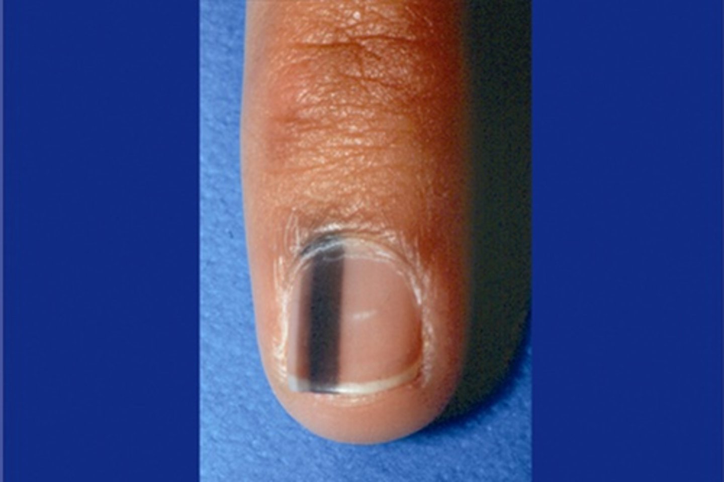 <p>- increased pigmentation of the nail bed, may be normal if found in multiple nails</p><p>- thin streak may be due to nevi</p><p>- larger streak considered subungual melanoma</p>