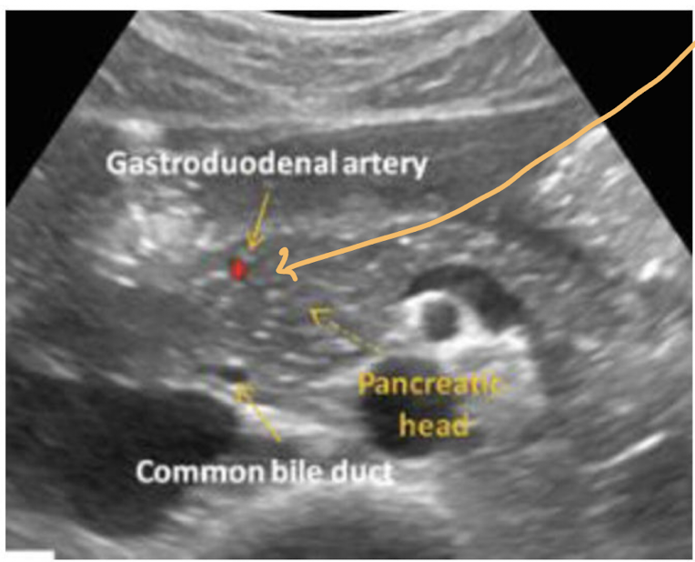 <p>1) anterior</p><p>2) posterior</p><p>*Turn on color doppler if you are unsure which is which. GDA should appear red</p>