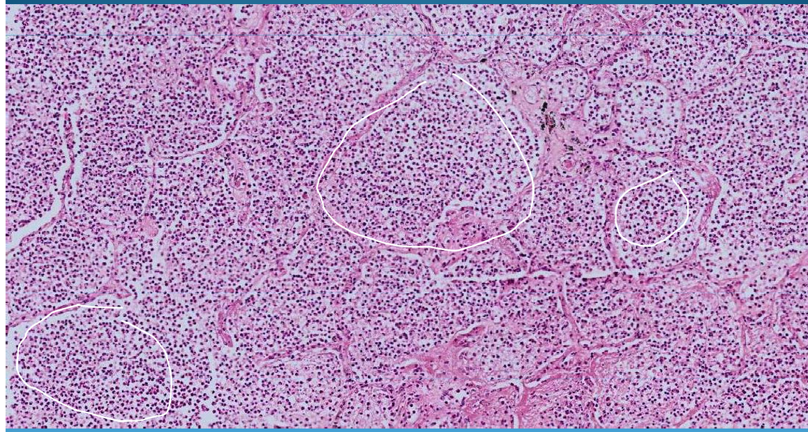 <p>LUNG:</p><p>Lobar pneumonia: monomorphic aspect of alveoli and gray hepatisation with PMNs, fibrin network </p>