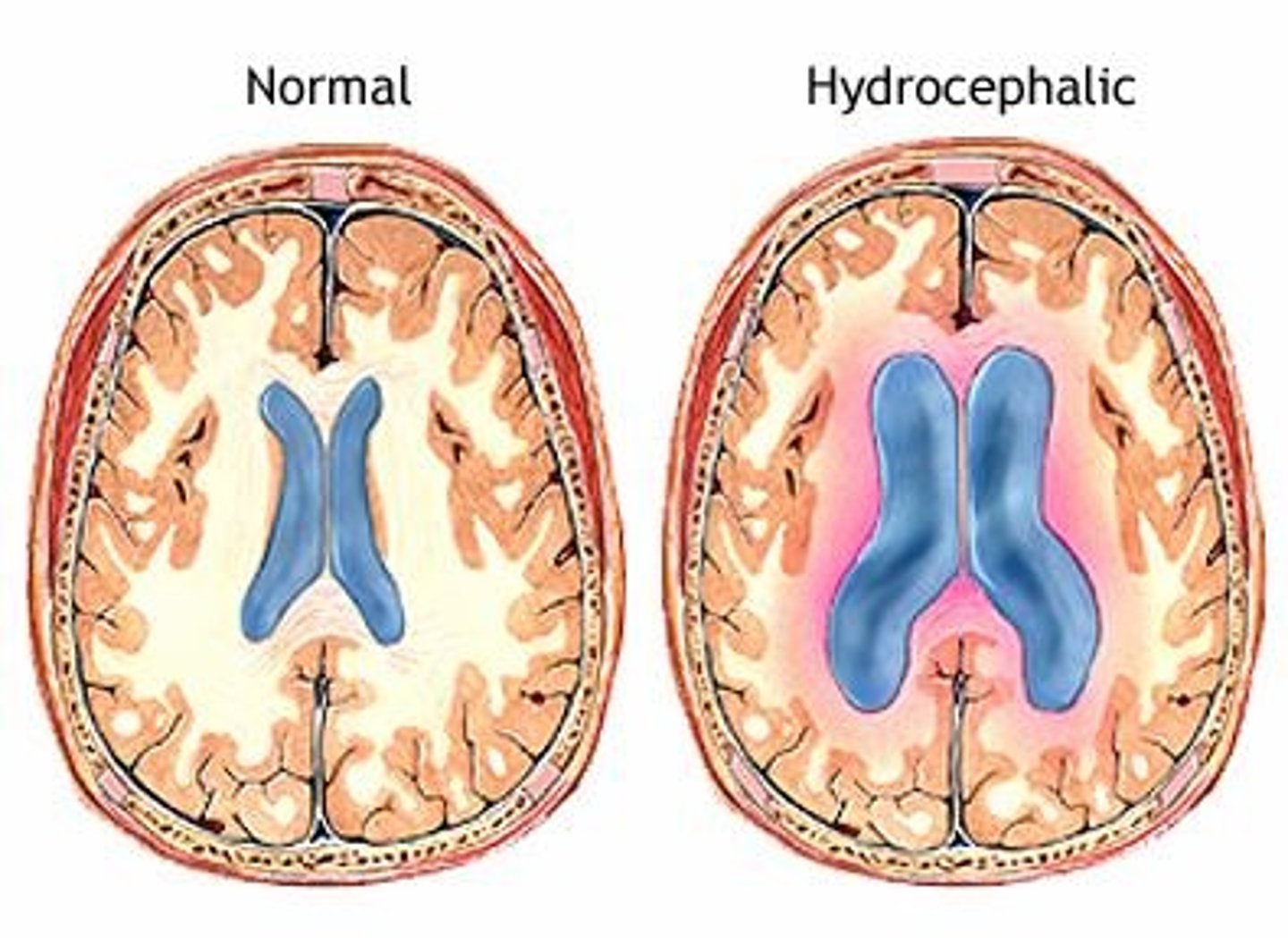 <p>Swelling of the brain from the inflammatory response; inflammation my cause brain to compress against the skull which can result in brain tissue death</p>