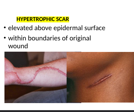 <p>elevated above epidermal surface, within boundries of original wound</p>