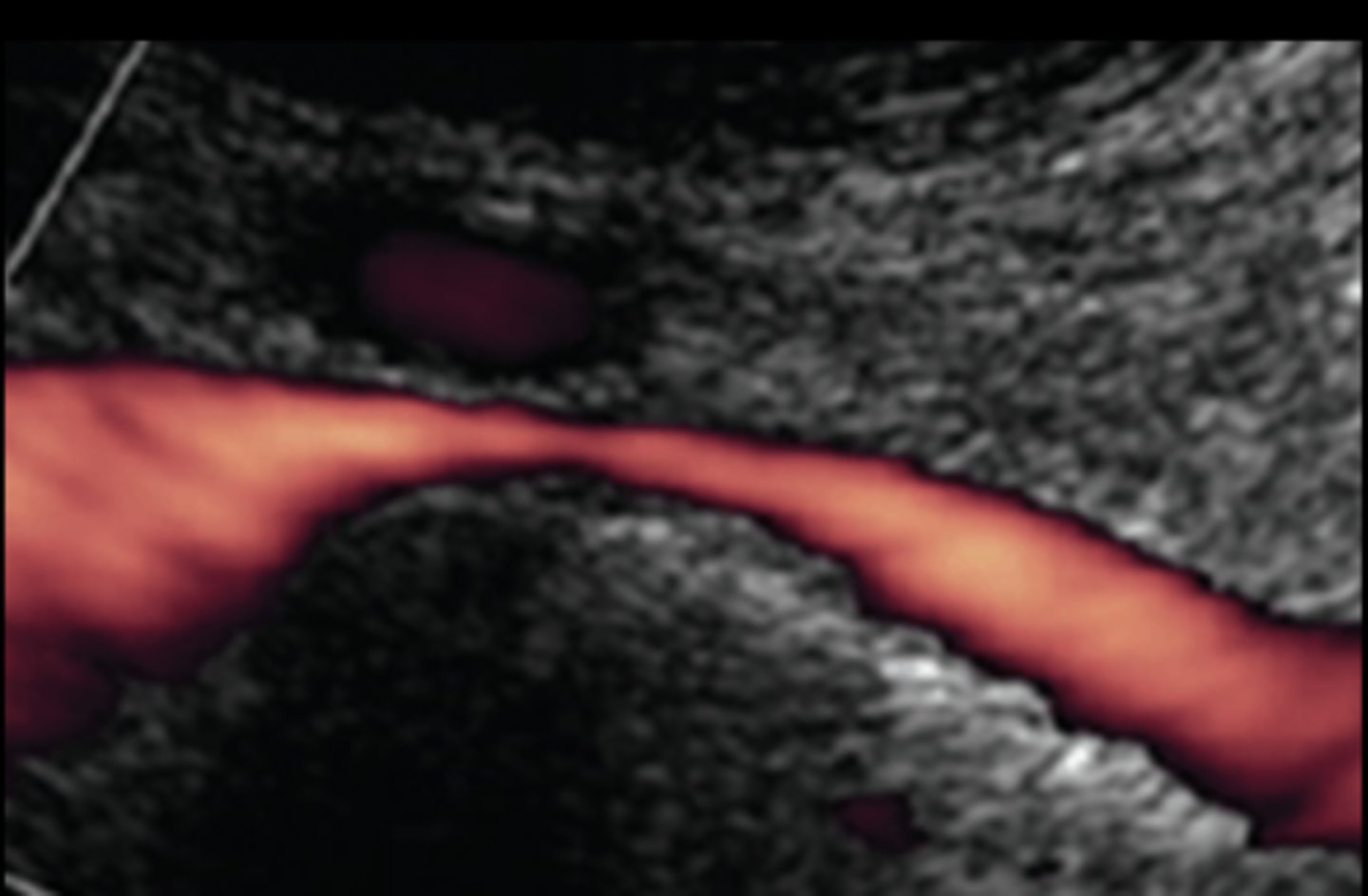 <p>Iliac vein is compressed between iliac artery and vertebral body</p><p>More common on left side</p><p>Can present as iliofemoral DVT or lower extremity edema/insufficiency</p><p>Treated by stent/balloon</p>