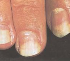 <p>painless separation of whitened nail plate from nail bed (enlarged free edge), often from traumatic forces, starts distally and progresses proximally</p>