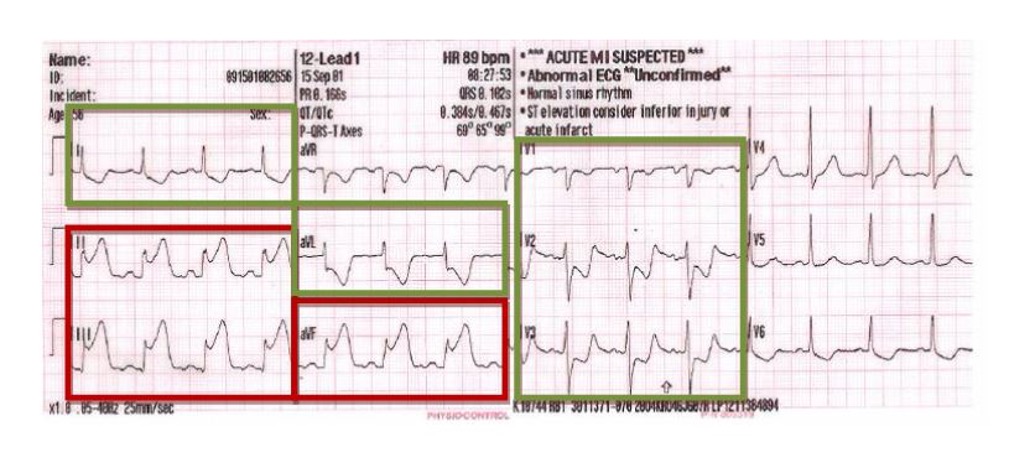 <p>mirror image of cardiac event on opposite leads which look at same area of heart</p><p>confirmatory sign of cardiac ischemia</p>