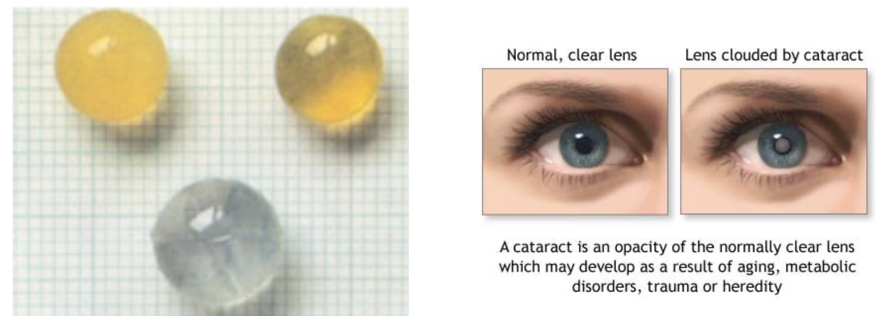 <p>An opaque lens caused by genetics or teratogens like rubella or radiation.</p>