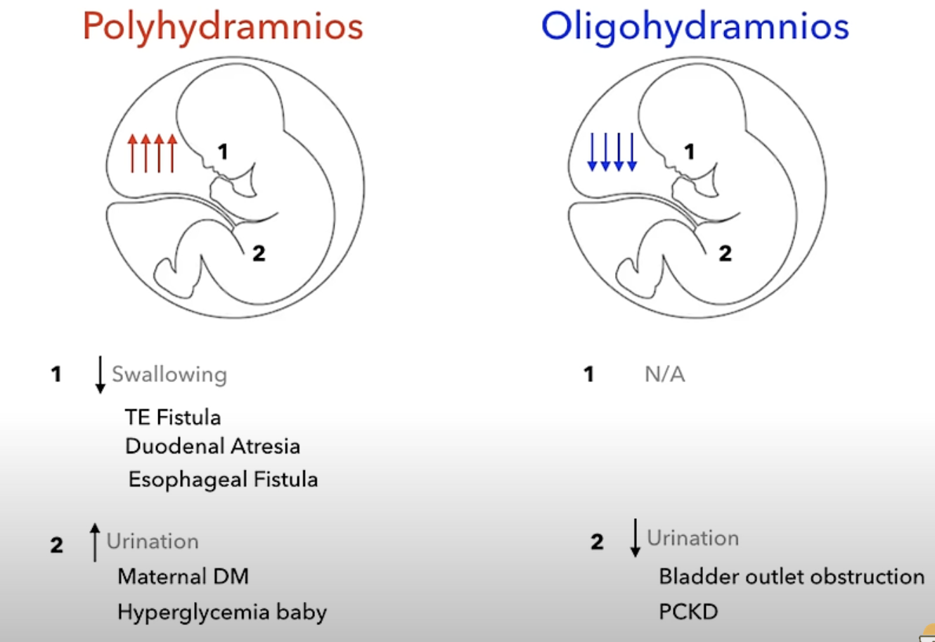 <p> excess of amniotic fluid in the amniotic sac.</p>