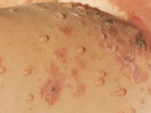 <p>large circumscribed, elevated, superficial cavity of fluid</p>