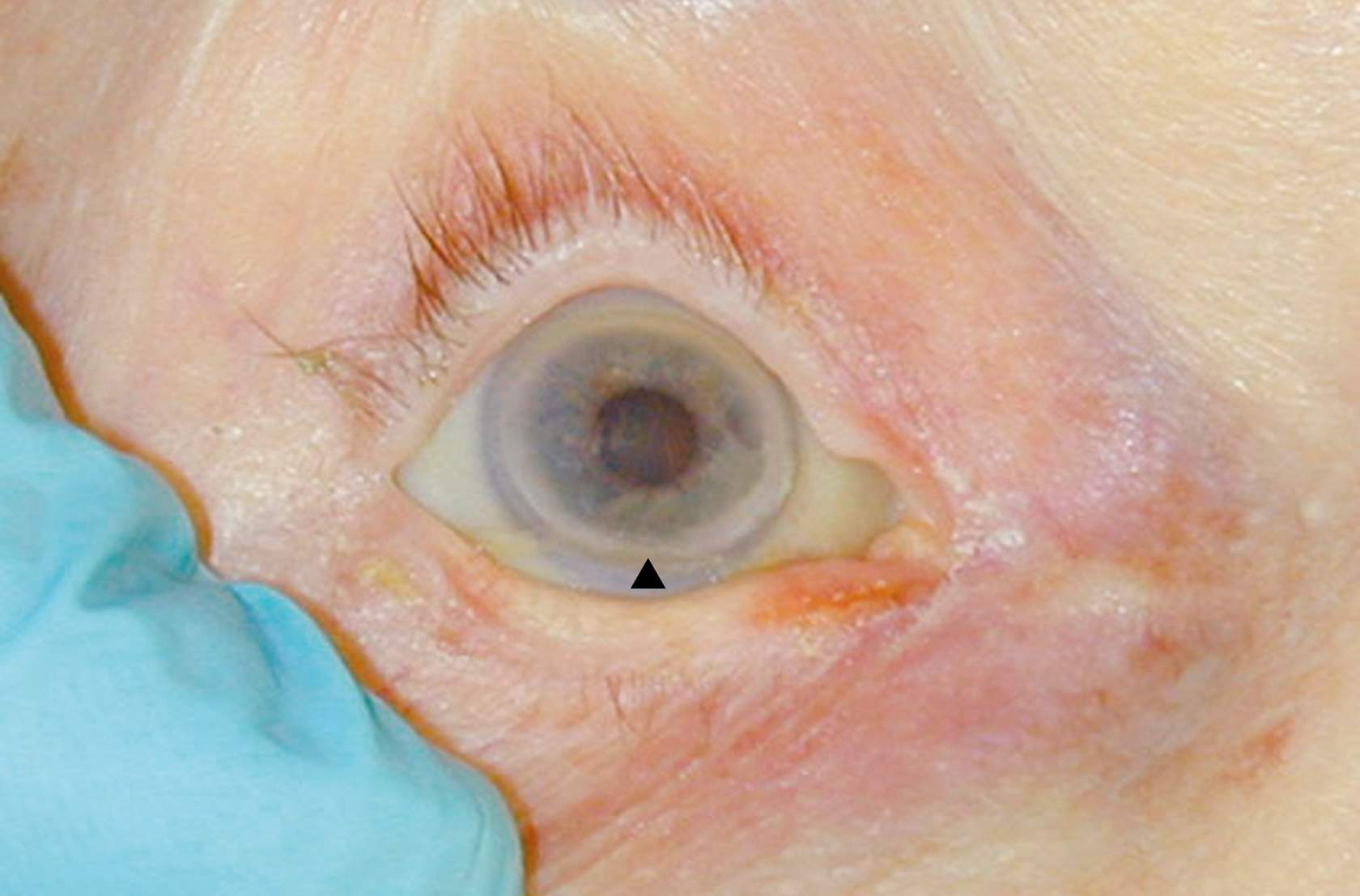 <ul><li><p><span>grey/white ring around the iris</span></p></li><li><p>sign of hyperlipidaemia in young patients (normal for old)</p></li></ul><p></p>