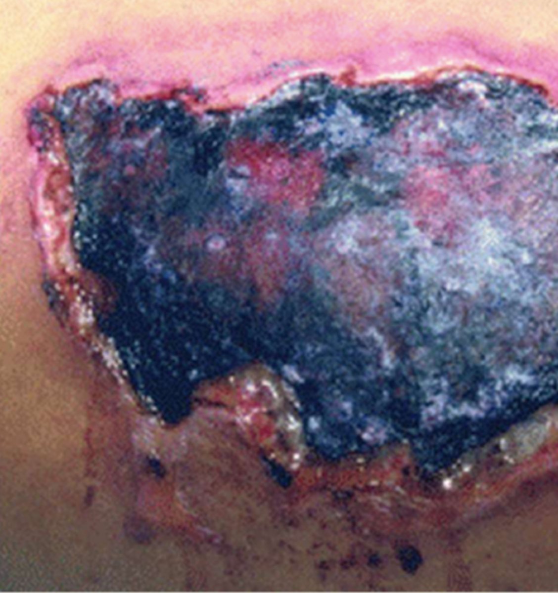 <p>¿lesión?</p><p>¿primaria o secundaria?</p>