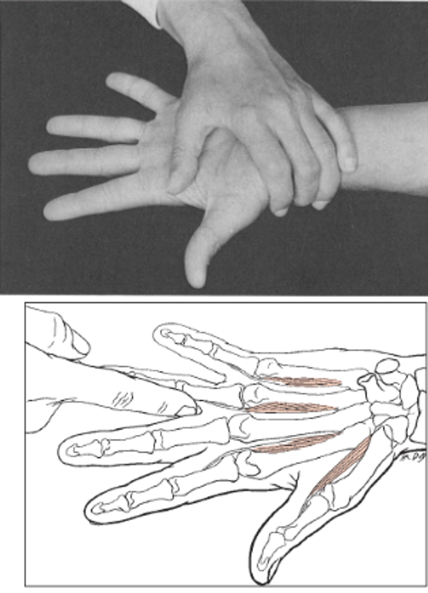 <p>Fő működés: addukció (II, IV, V. ujjak a III-ashoz)</p><p>KH: könyök flexio, alkar supinatio, kézhát az asztalon. I. ujj félre, többi ujj abductioba</p><p>Rögzítem a metacarpusokat és a csuklót</p><p>Közelítse a II-t, IV-t és az V ujjat</p><p>Ellenállás: proximalis phalanxra belülről</p>