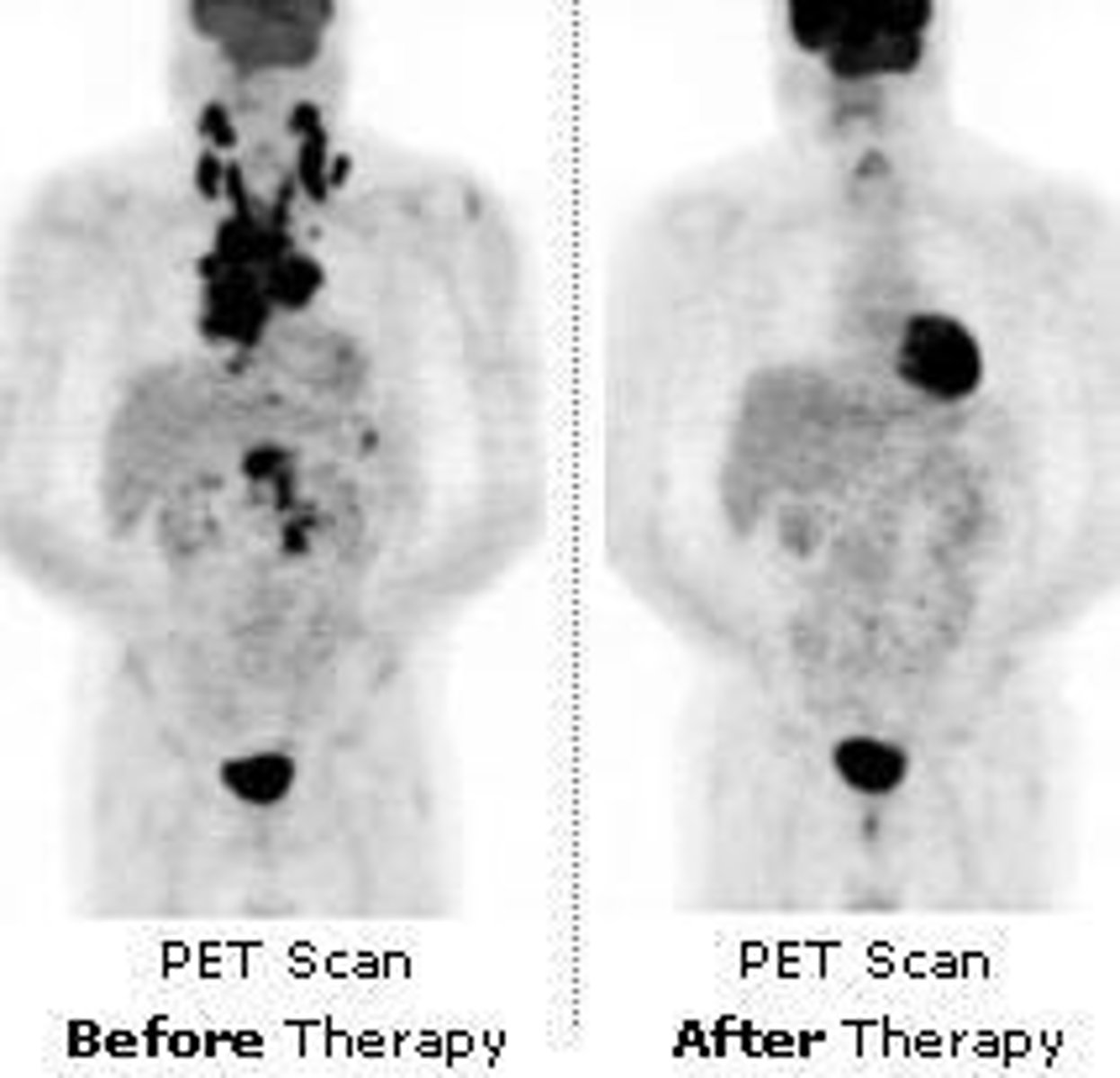 <p>To visualize metabolic processes in the body after injecting a radioactive sugar (FDG 18).</p>